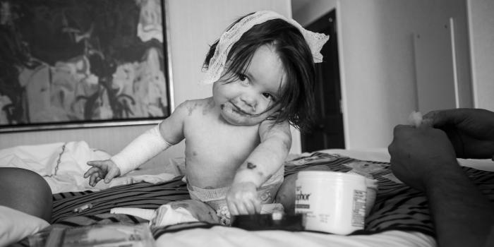 Child with EB