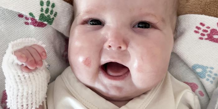 Addelyn's Epidermolysis Bullosa Story