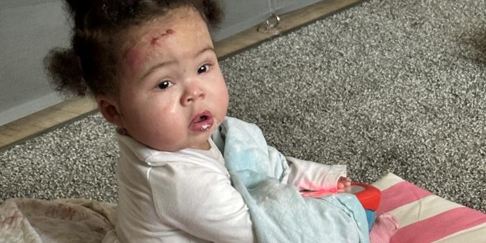 Alayah Epidermolysis Bullosa Story